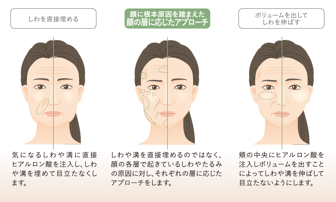 部分的な注入よりも、全体を整えることで圧倒的に自然で若々しい印象になります。